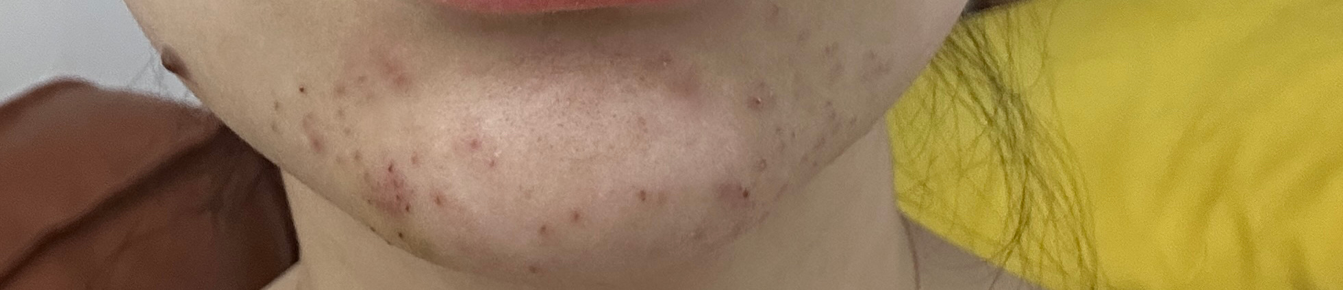 针清第三天结痂部分掉了估计要后天才能化妆恢复期需要一周左右苍天 ​​​