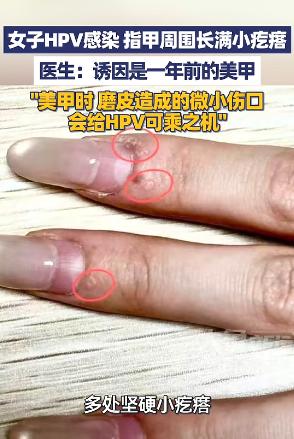 5月9日，浙江杭州一女子发现指甲边长出粗糙的硬疙瘩，去医院一查确诊感染HPV。起