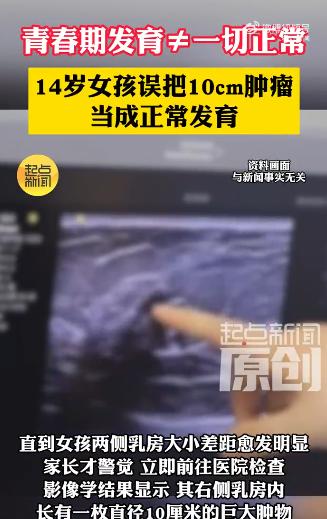 “太吓人了！6月16日报道，西安，14岁初二女生洗澡时无意摸到右侧乳房有个硬块，