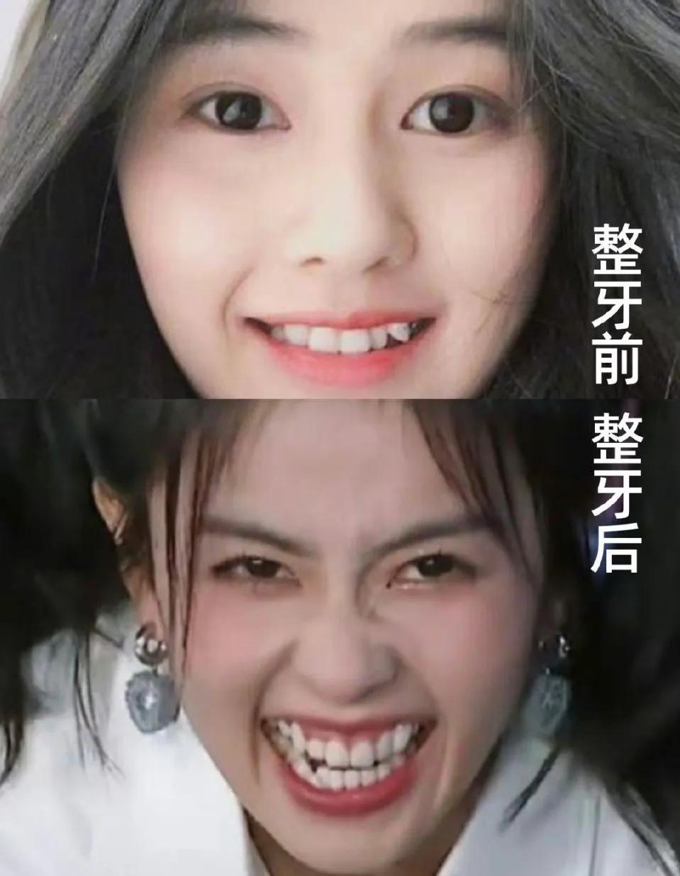 每次看跑男，看到白鹿都想问，为什么不去整牙啊！
后来翻到她刚出道时候的生图，发现