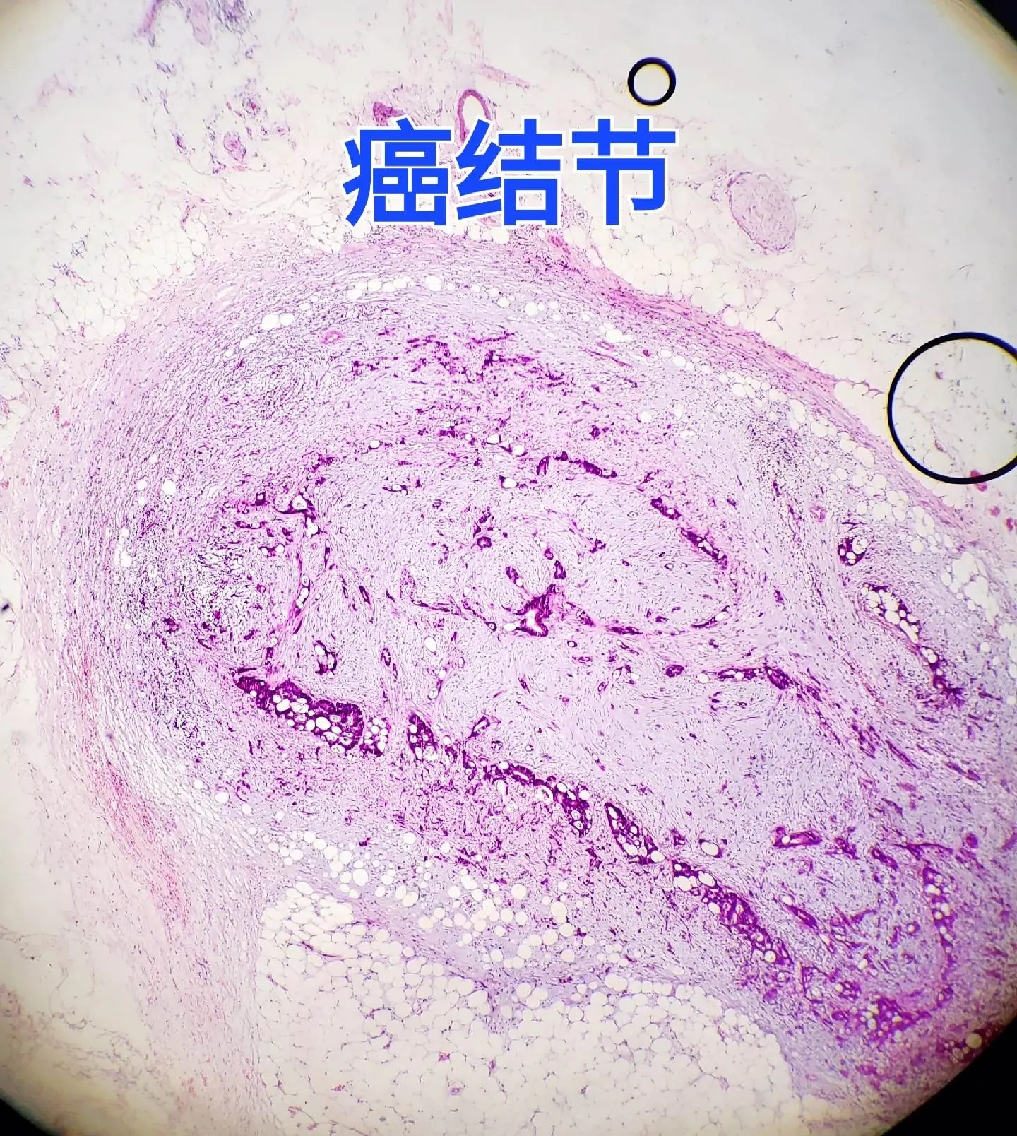 溃疡性肿块