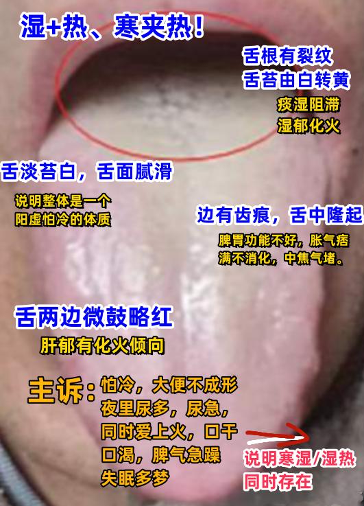 粉丝舌诊案例分享：寒热夹杂，湿热下注，肝郁气滞，心肝火旺，痰湿阻滞[谢谢][谢谢