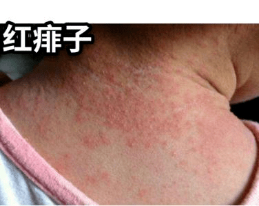 宝宝夏天出现红痱子，可以这样治！每天用温水帮孩子洗澡2~3次，洗完澡及时擦干，保
