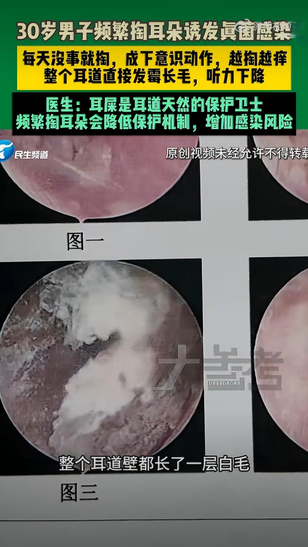 河南郑州有个30多岁的男子，没事就爱掏耳朵，早上掏、晚上掏，中午没事也掏，甚至还