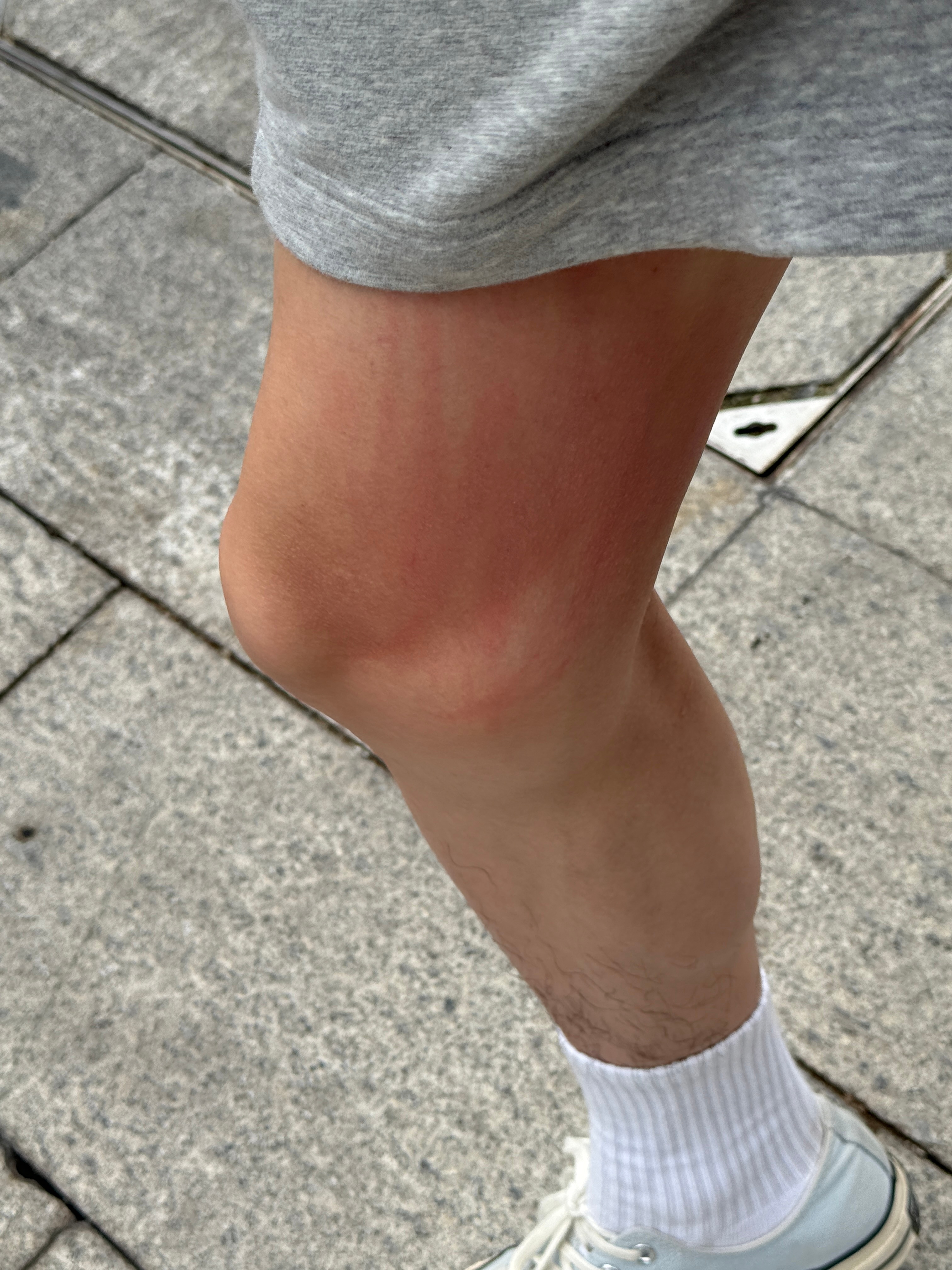 是寻麻疹最讨厌的夏天… 