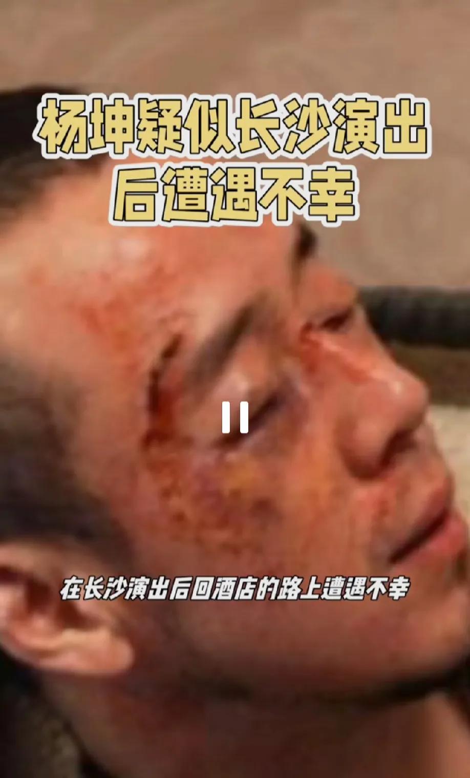 杨坤长沙被打！满脸鲜血！

就在今天，之前的几个小时，在长沙演出完的杨坤，在路上
