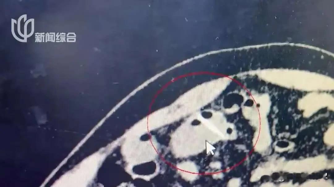 上海，一大爷在吃甲鱼时，不小心吞了一片甲鱼骨头，当时觉得没事，可过了3个多小时后