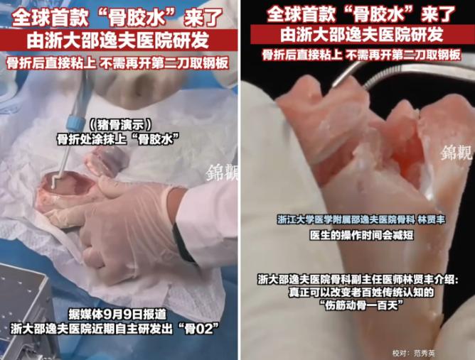 万万没想到，浙江邵逸夫医院研发出了全球首款骨胶水——“骨02”，以后骨折骨碎不用