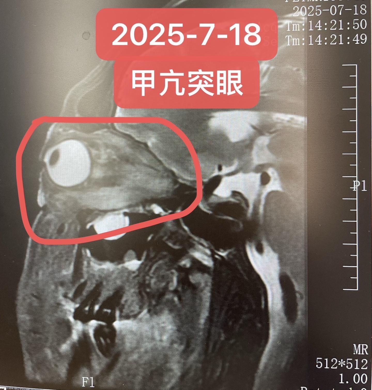 甲亢伴突眼，严重影响面容。甲亢控制，但出现的突眼仍在，影响面容！采用精...
