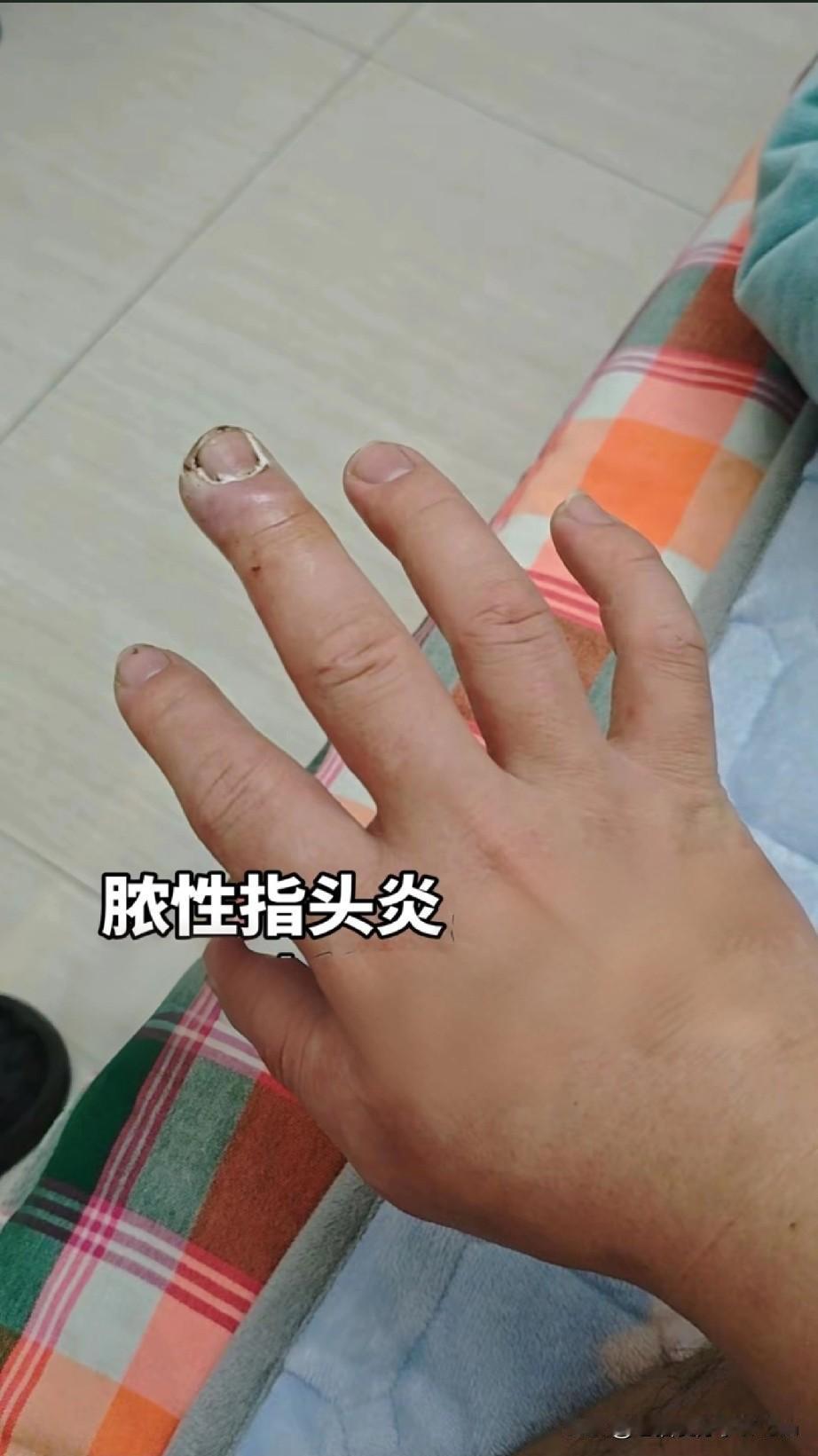 这种小症状千万别大意
 
今天看到一个案例真的后怕！
杭州11岁的小女孩小雨，一