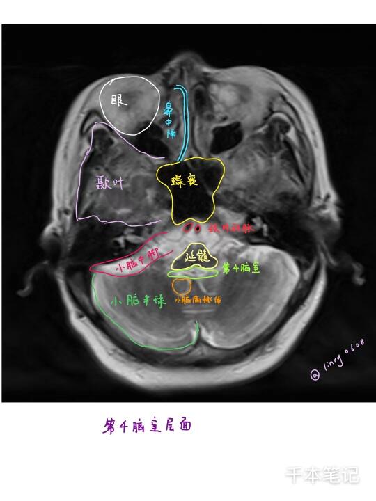 医学生绘本🎨第88弹【颅脑MRI】
