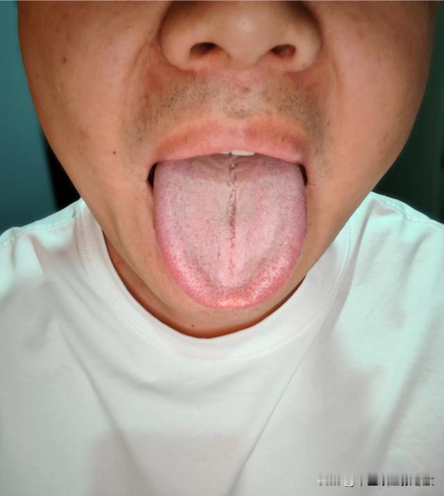 但凡是这种勺子舌，裂纹还这么长的，男科没一个好的
大哥主诉：时间短，控制不住，腰