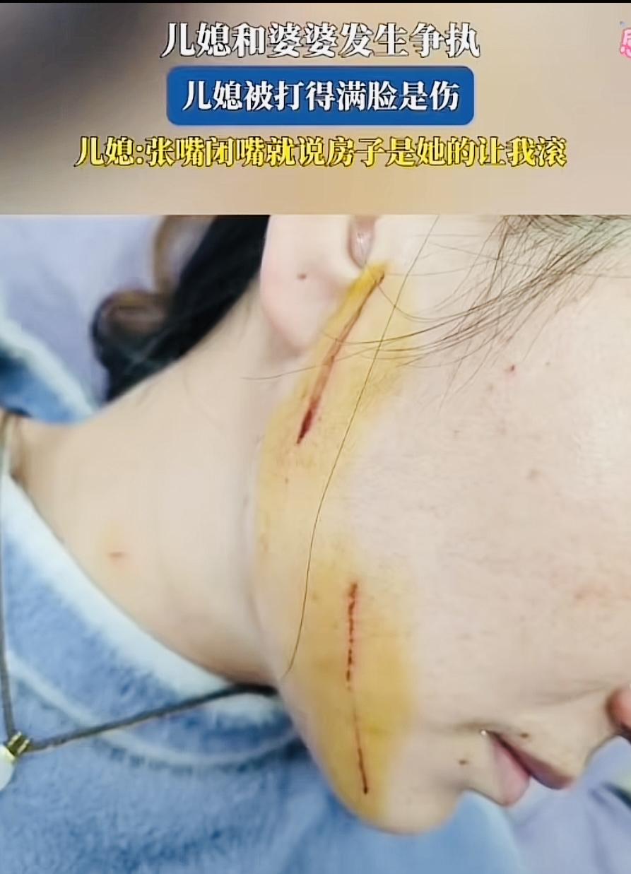 女人遇上恶婆婆就是人生中最大不幸！有位女士被婆婆抓得满脸花，一看脸部伤情就是刚发