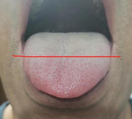上热下寒，不难！

很多朋友都知道上热下寒，觉得又是热又是冷的，肯定很难搞！
其
