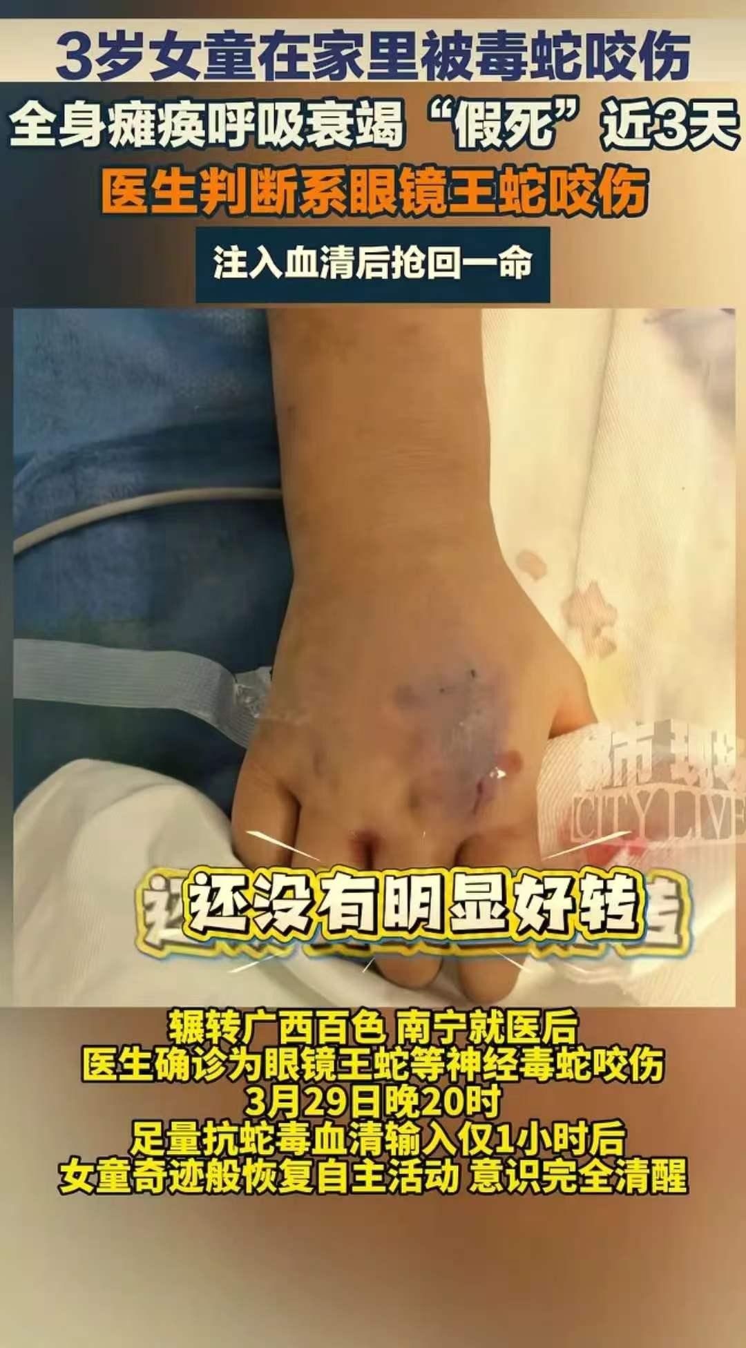 “真是奇迹！”云南文山，一3岁女童在家中意外被毒蛇咬伤，送医仅半小时，孩子已全身