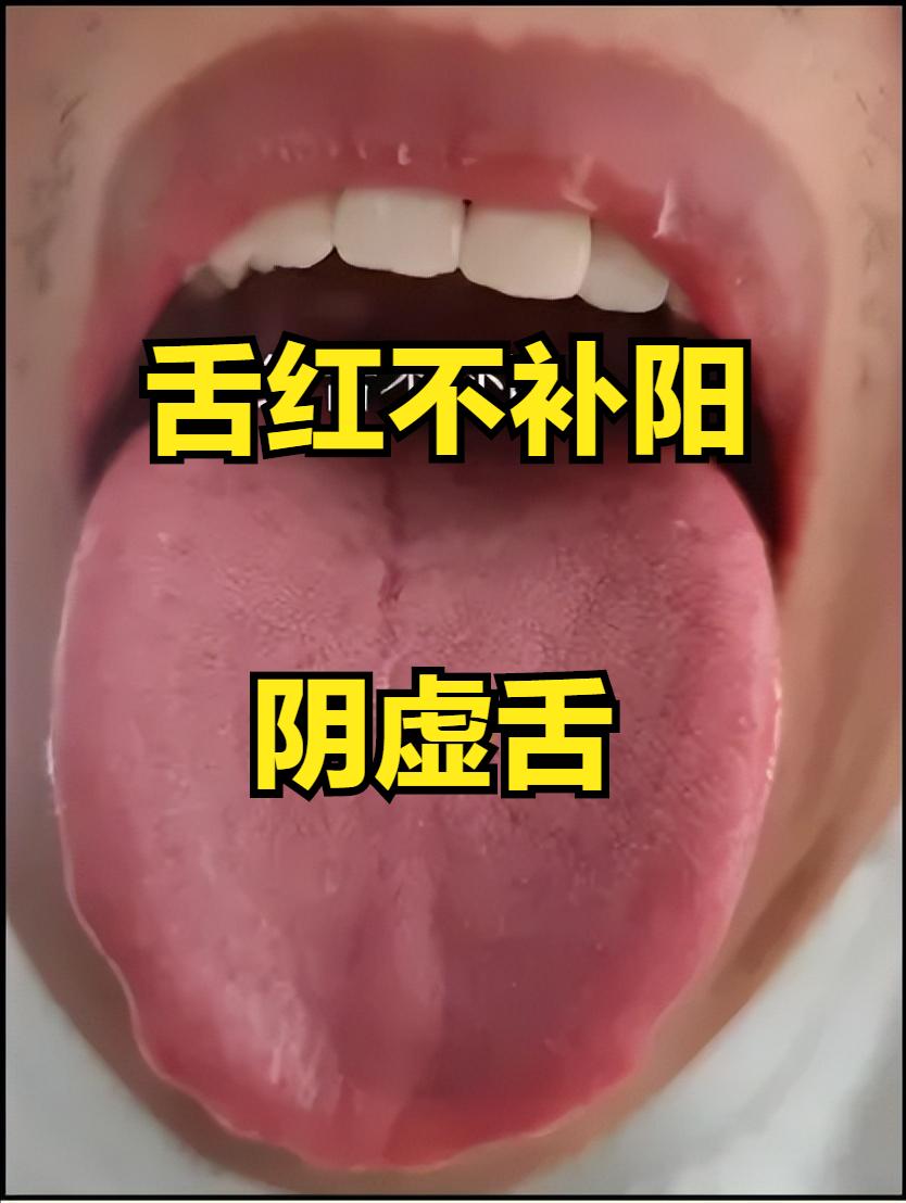 补肾只需记住一句话：舌红不补阳，舌白不滋阴！
 
①舌红不补阳（图一）
舌象：舌