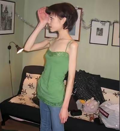 代价太惨痛！河南90后女生靠辟谷疯狂减重，

一个月瘦40斤，却换来有可能终身走