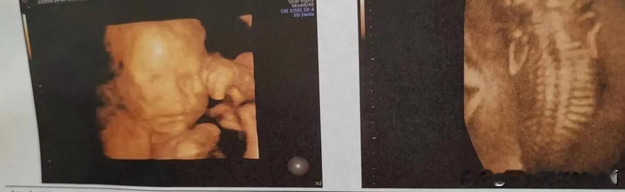 这大嘴宝宝，太像我哥了！就是不知道是男娃还是女娃。
四维彩超做出来了，嫂子说宝宝
