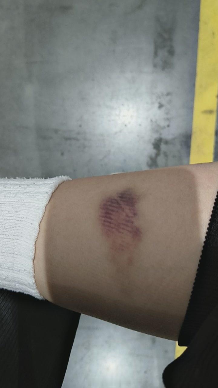 我是小沐茶 致我亲爱的身体        你好，我为什么身上这里青一块那里紫一块