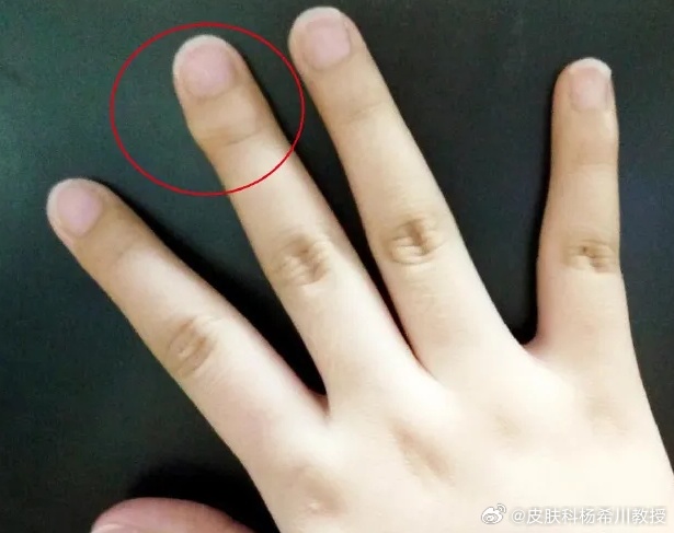 一句话科普  握笔的手指长的茧子叫胼胝，因为经常摩擦导致皮肤角质增厚，这也是学习
