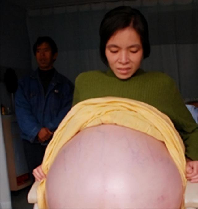 2007年，怀胎12个月的女子，在丈夫的陪同下，挺着巨肚，来到了广州医院检查，没
