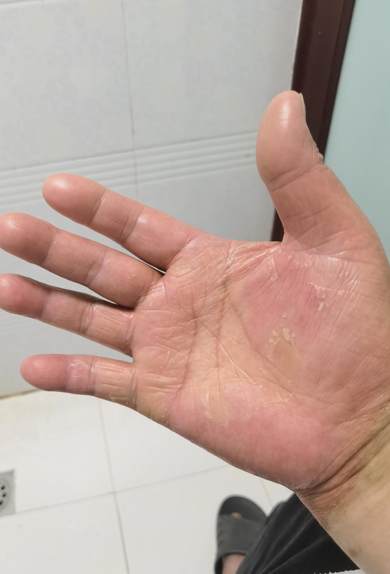 致刘钟主任
 
刘钟主任您好：
 
现将手掌、足底患处现状照片发送给您参考。自5