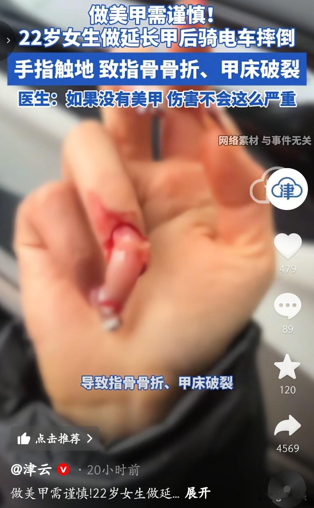 看得头皮发麻！做美甲竟让22岁女生摔成骨折！
 
这画面看着都疼！一位22岁女生