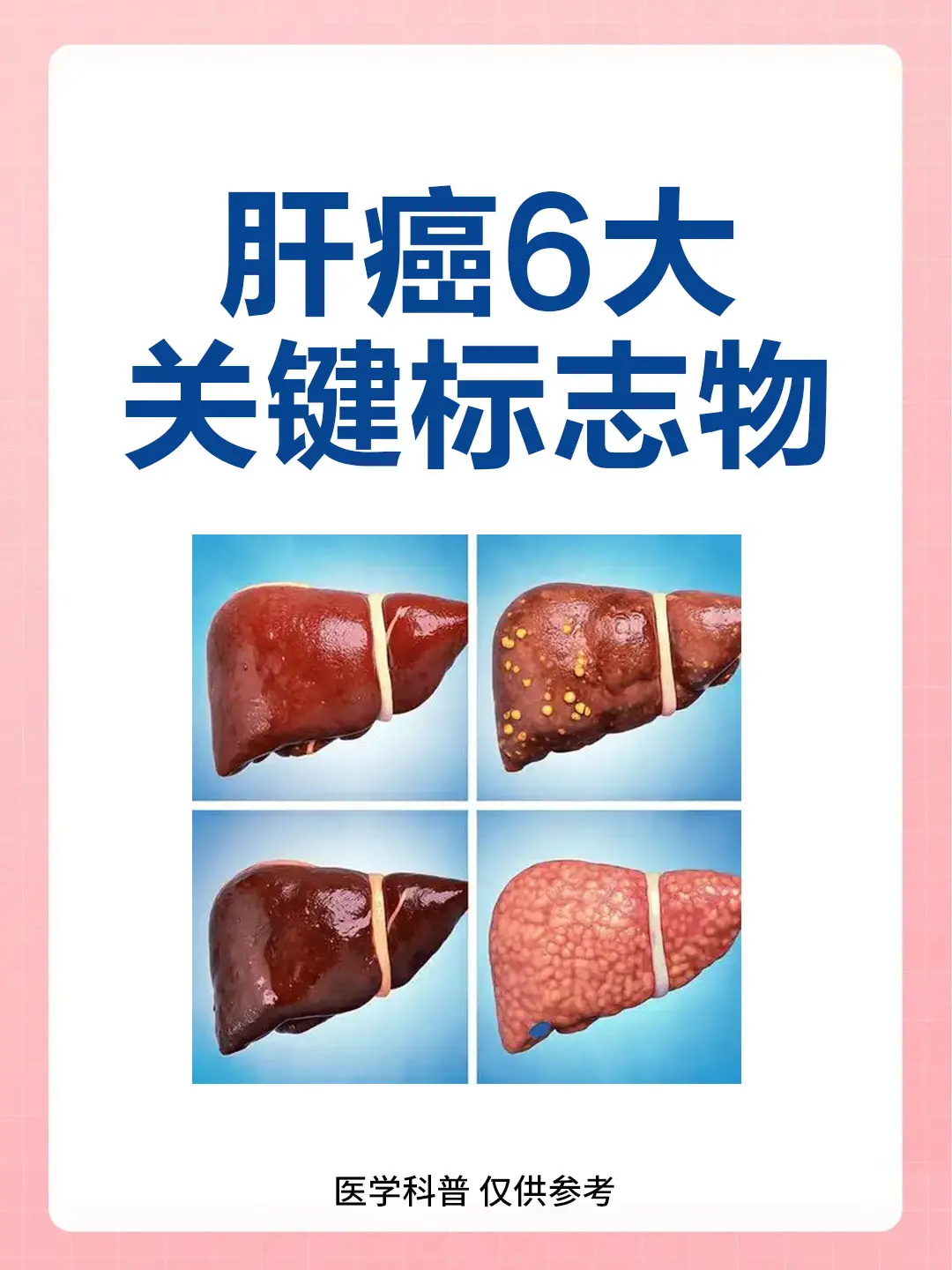 肝癌 甲胎蛋白 抖出健康知识宝藏