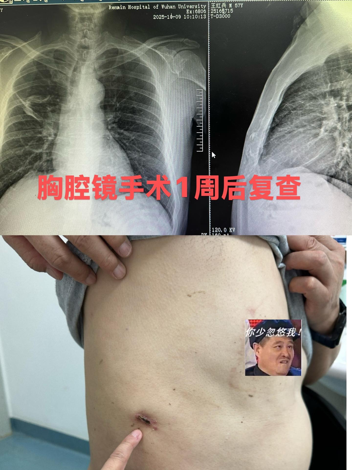 微孔肺结节切除。一周后复查