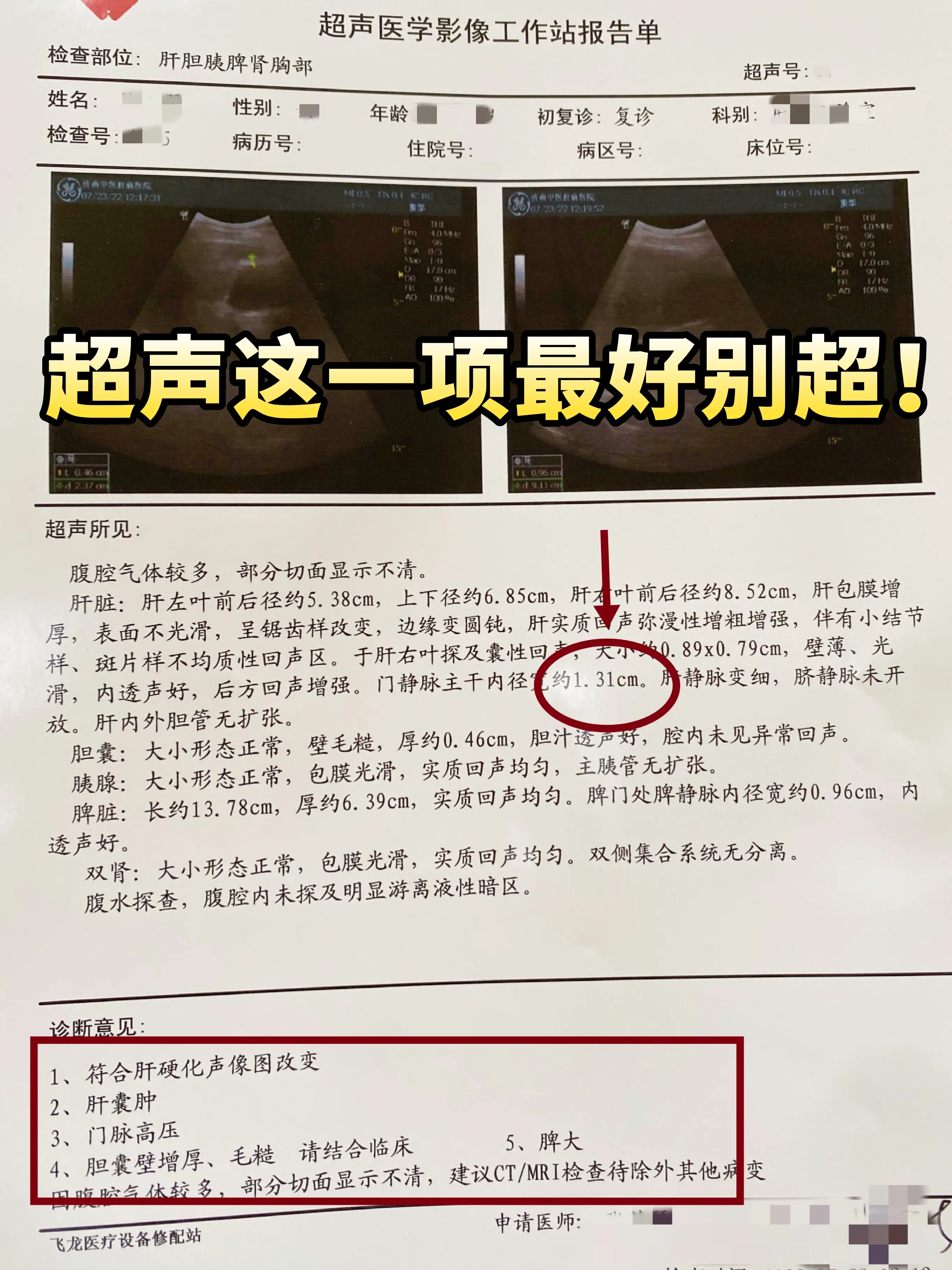 前几天收治了一位山东淄博的肝硬化患者，从他的彩超报告单上可以看到出现了...