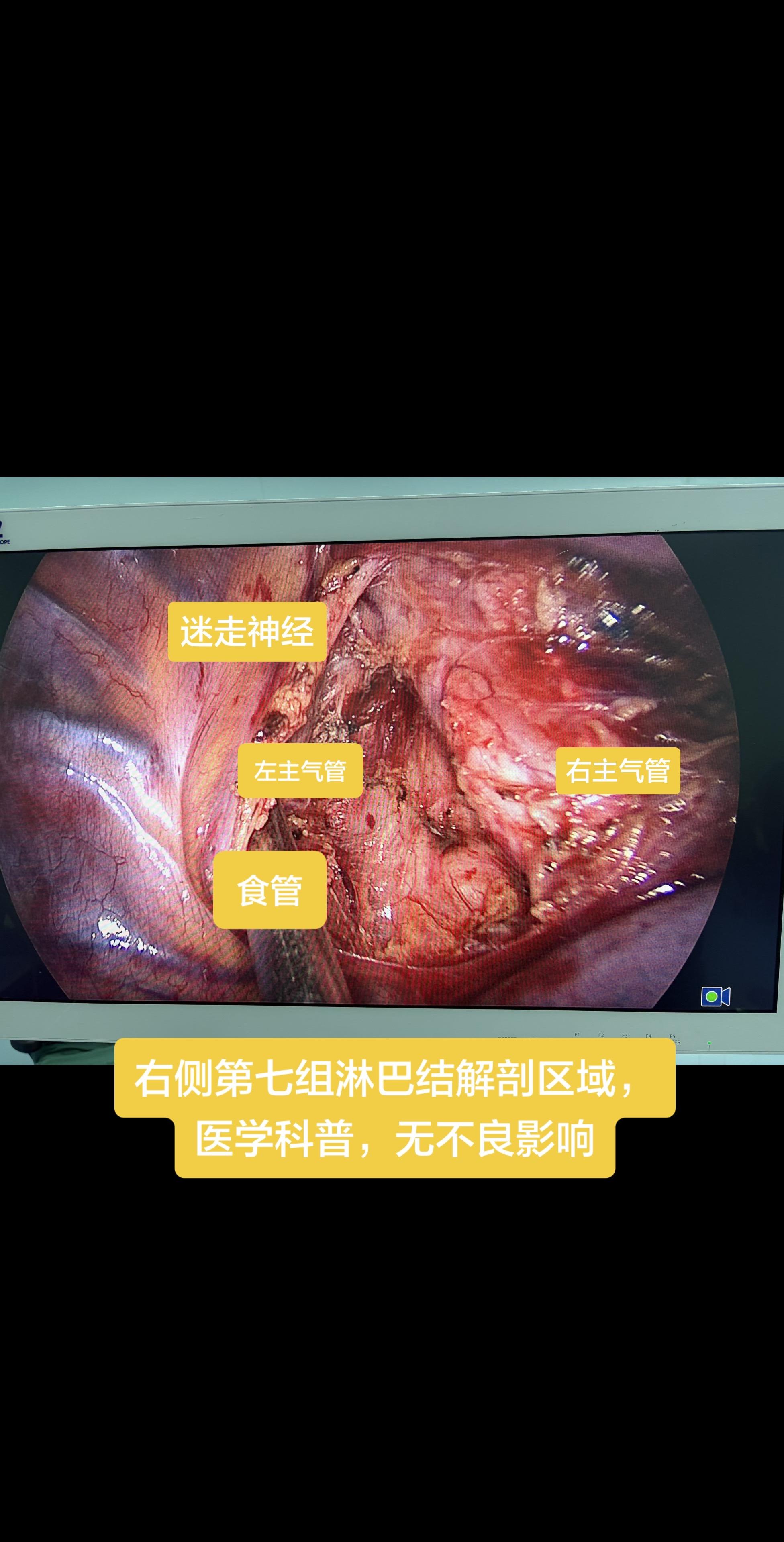 右肺癌区域淋巴结的解剖，医学科普，无不良影响……