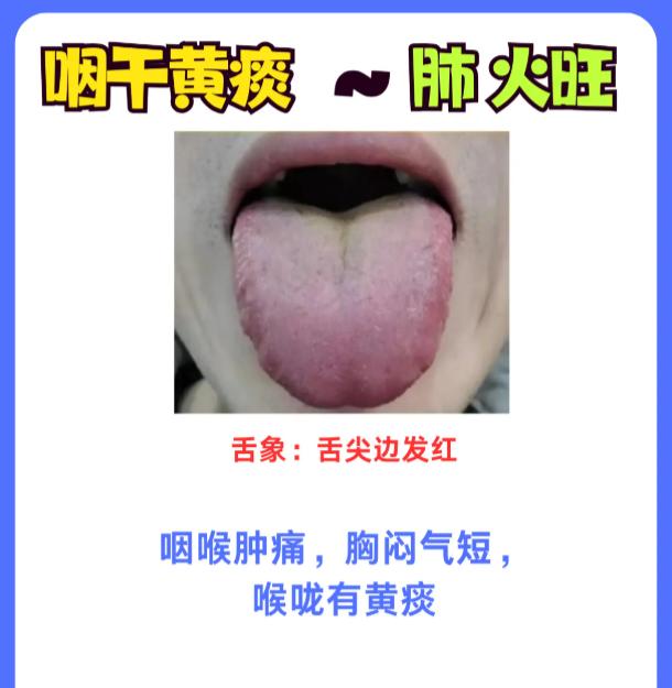 看舌辨上火：5 类脏腑火全解析