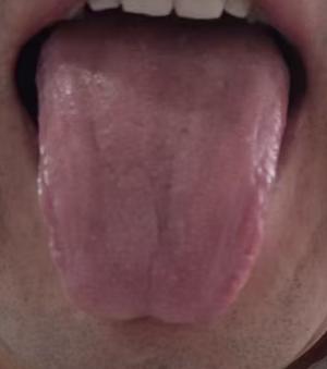 阴虚火旺兼肝郁化火，男士体质舌诊辨证与调养思路






有体型偏胖的粉丝前来