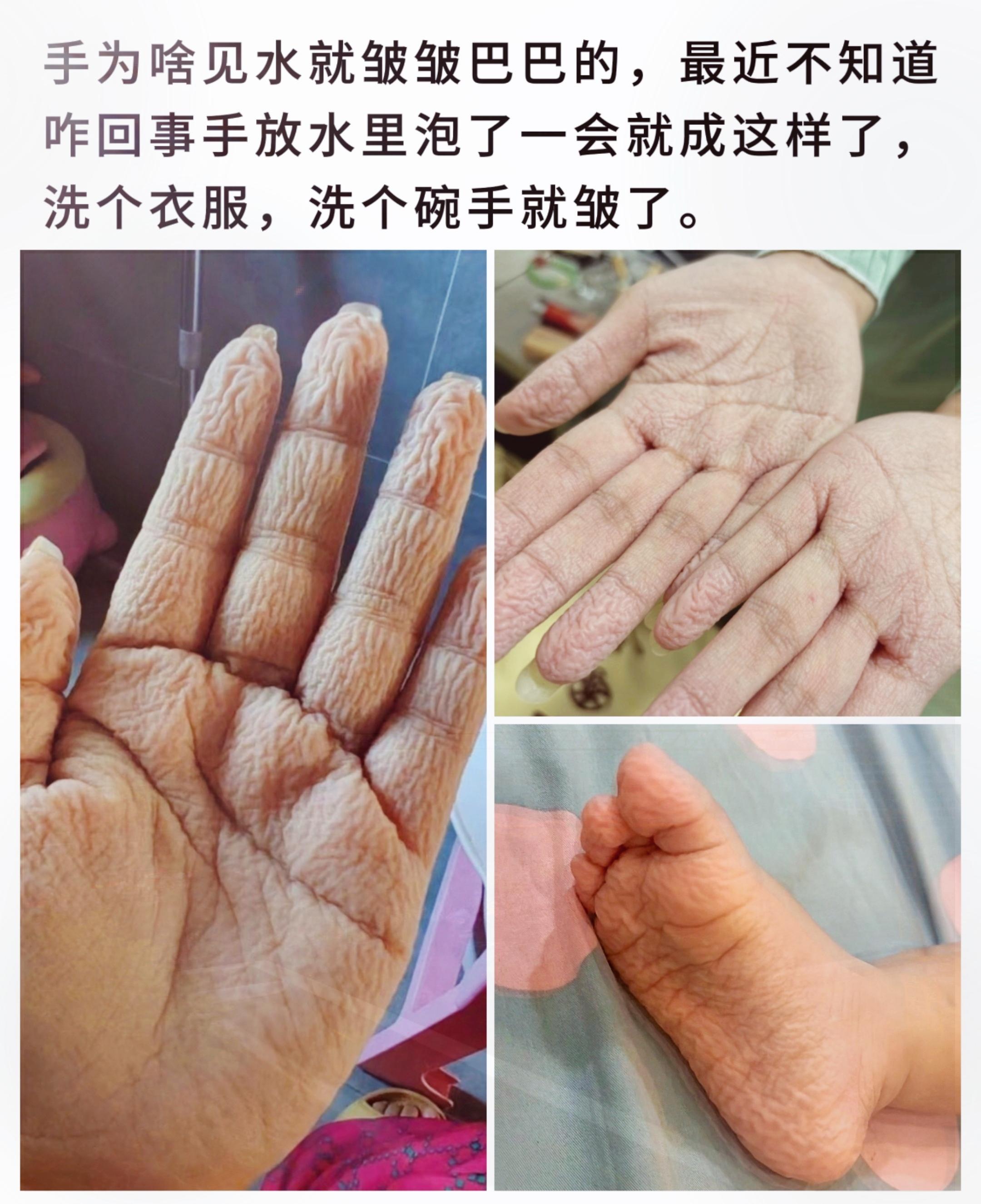 手为啥见水就皱皱巴巴的，最近不知道咋回事手放水里泡了一会就成这样了