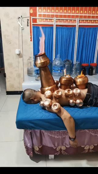 这是治疗什么病的？
患者躺在床上，身上扣满了铜罐子？
这看起来真是太吓人了！病是
