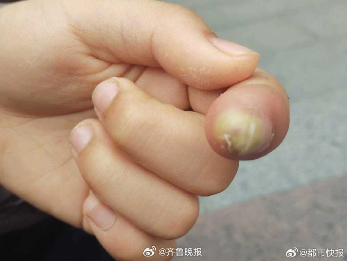 【#女孩手指刺了个小伤口险截指#】 春节前，杭州11岁小雨左手食指被异物刺了个微