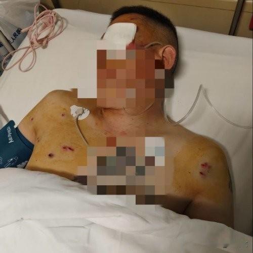 取170万遭劫匪暴打失明！银行保安全程围观，这安全保障何在？
 
去年7月2日郑