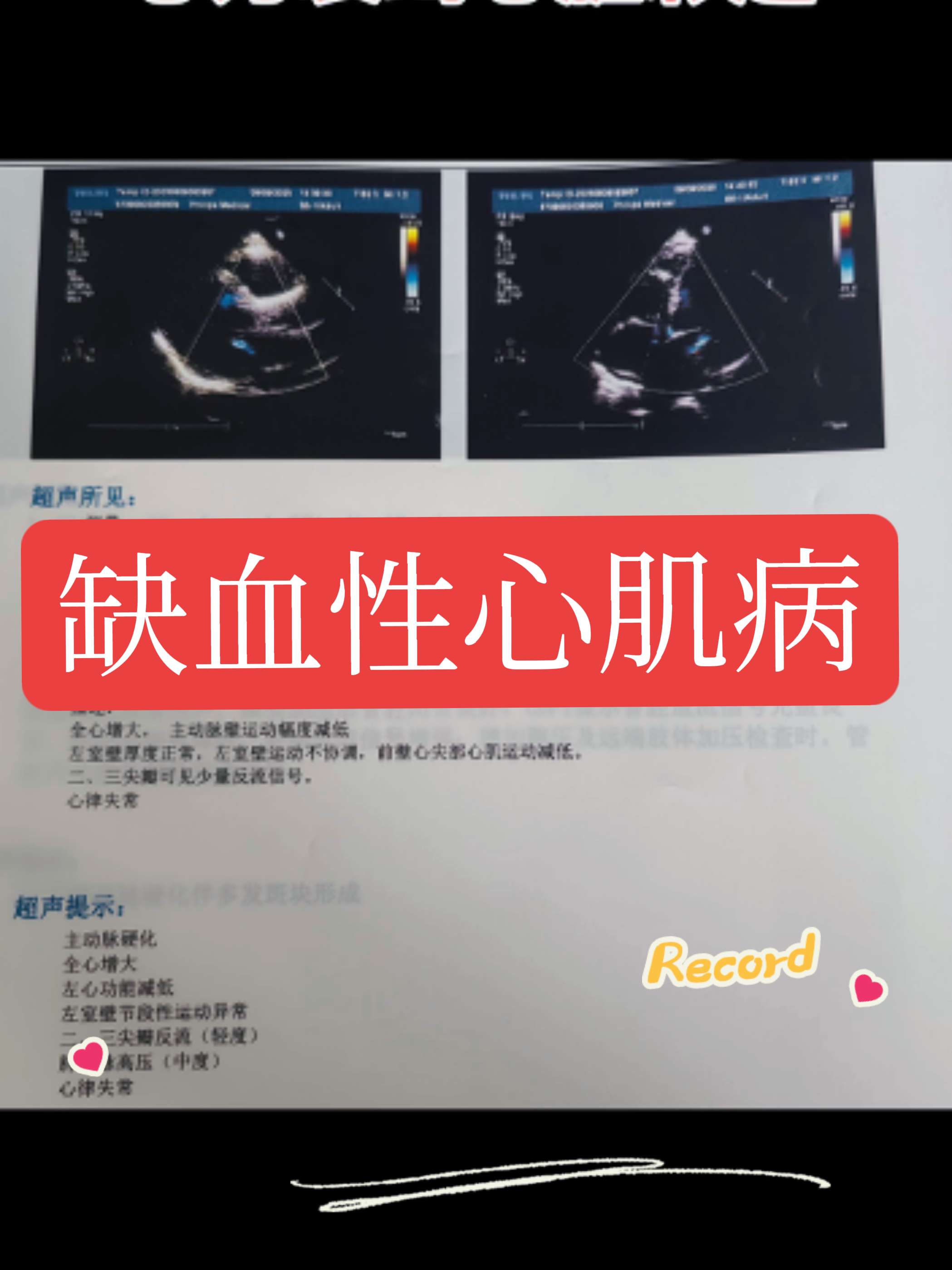 心力衰竭。初次接诊这位患者，考虑扩张型心肌病，前两天做了冠脉造影，证实...