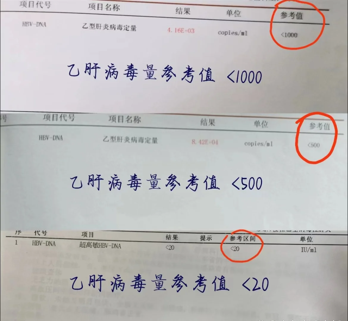 病毒量低于这个数才是安全的 过去很多患者以为病毒控制在500以下就是安...