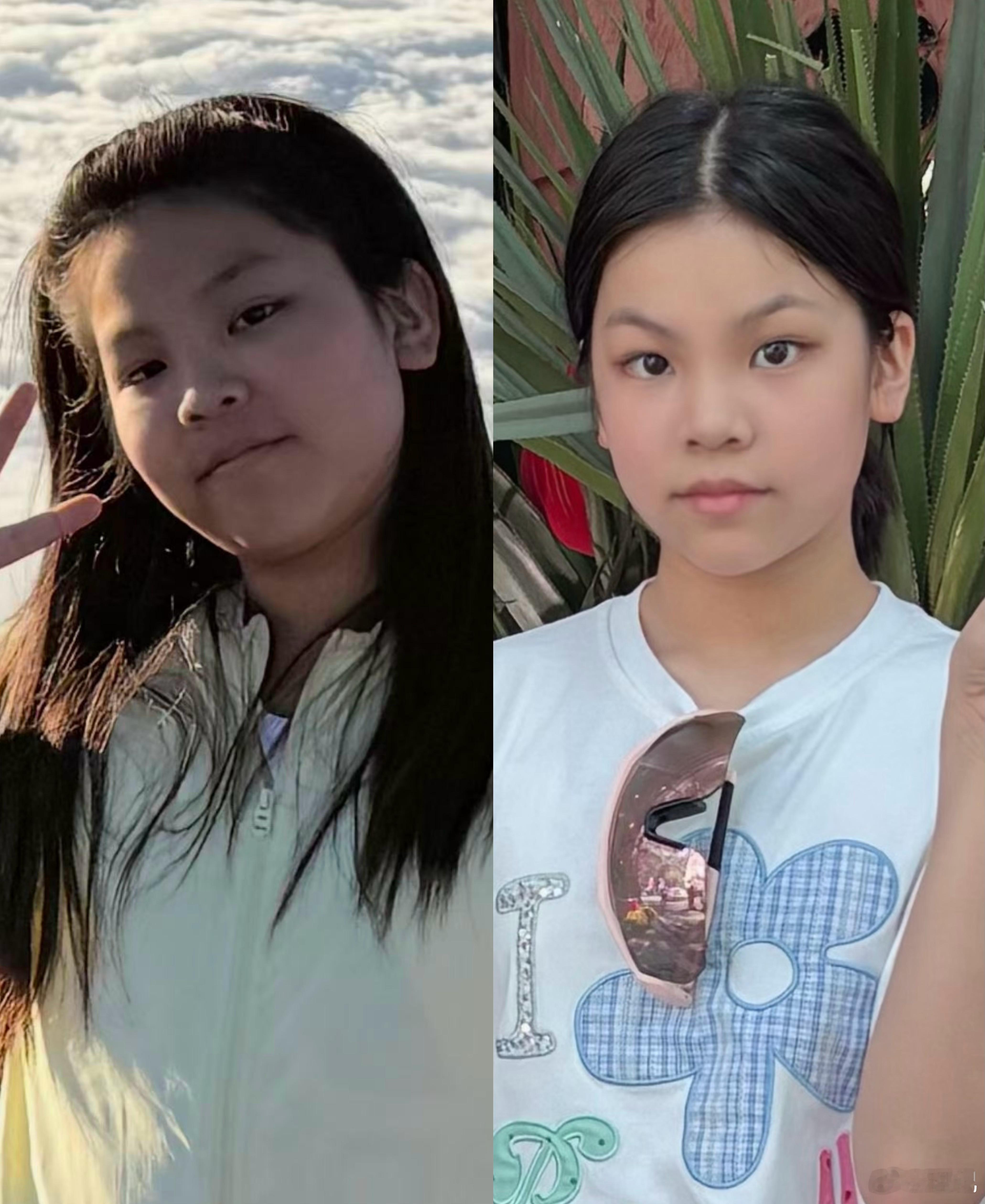 「家长一定要给孩子控糖！太重要了！」左图是去年二月，右图是今年二月。我女儿今年1