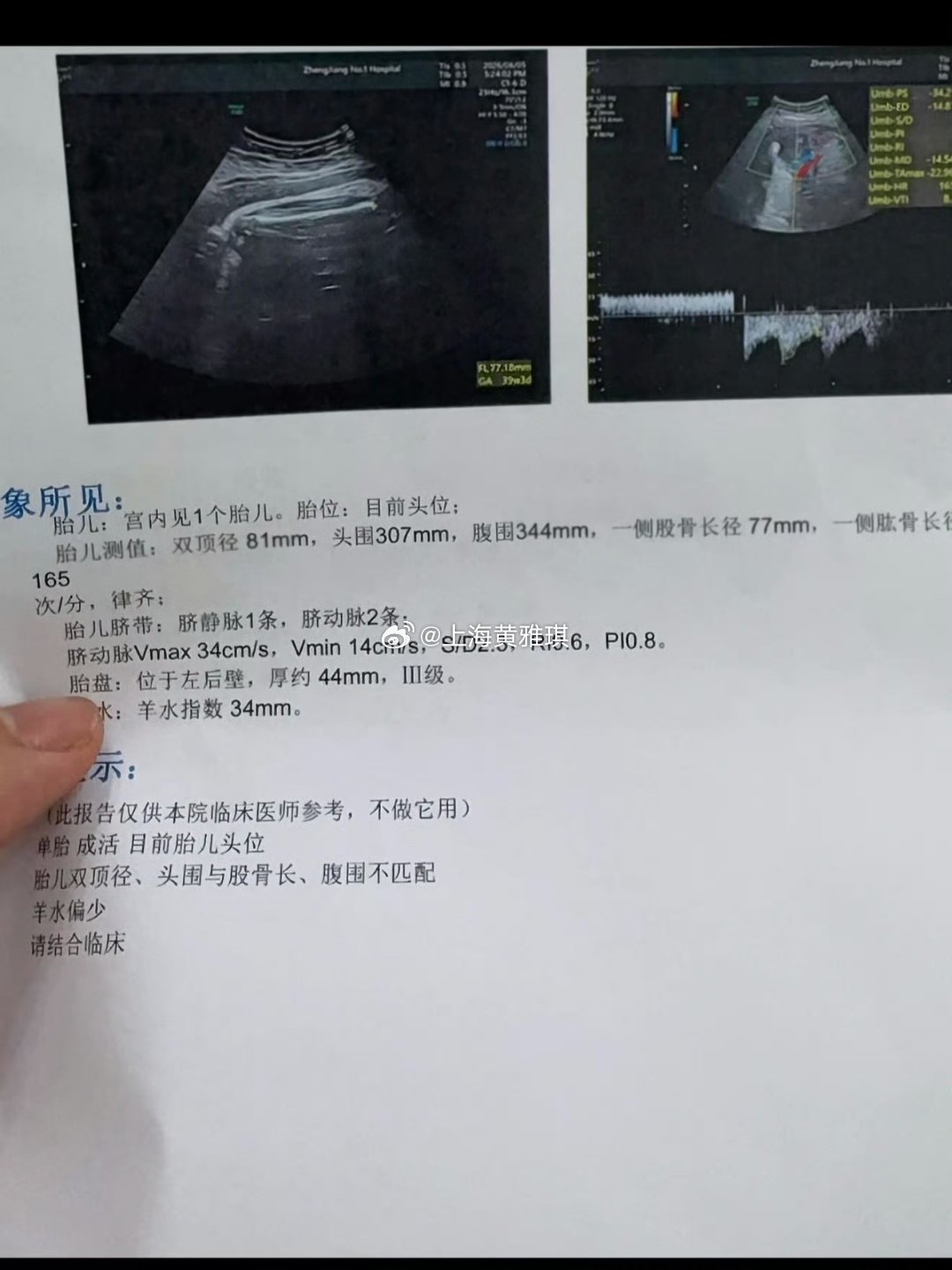 女子腹痛以为肠胃炎结果生了个娃女子生娃前4小时才知道怀孕江苏镇江一则经历刷新认知