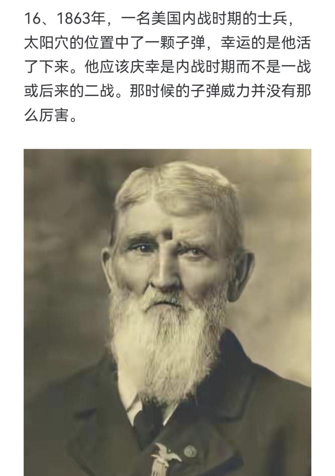 1863年 一名美国内战时期的士兵 太阳穴的位置中了一颗子弹