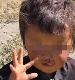 不是光免个手术费就完事，连机票、接机、住院、吃饭、营养品、衣服、以后复查祛疤的钱