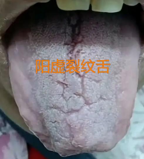 教你一招，轻松调理阴虚裂纹舌、阳虚裂纹舌！


 
首先我们来看一个阳虚裂纹舌。