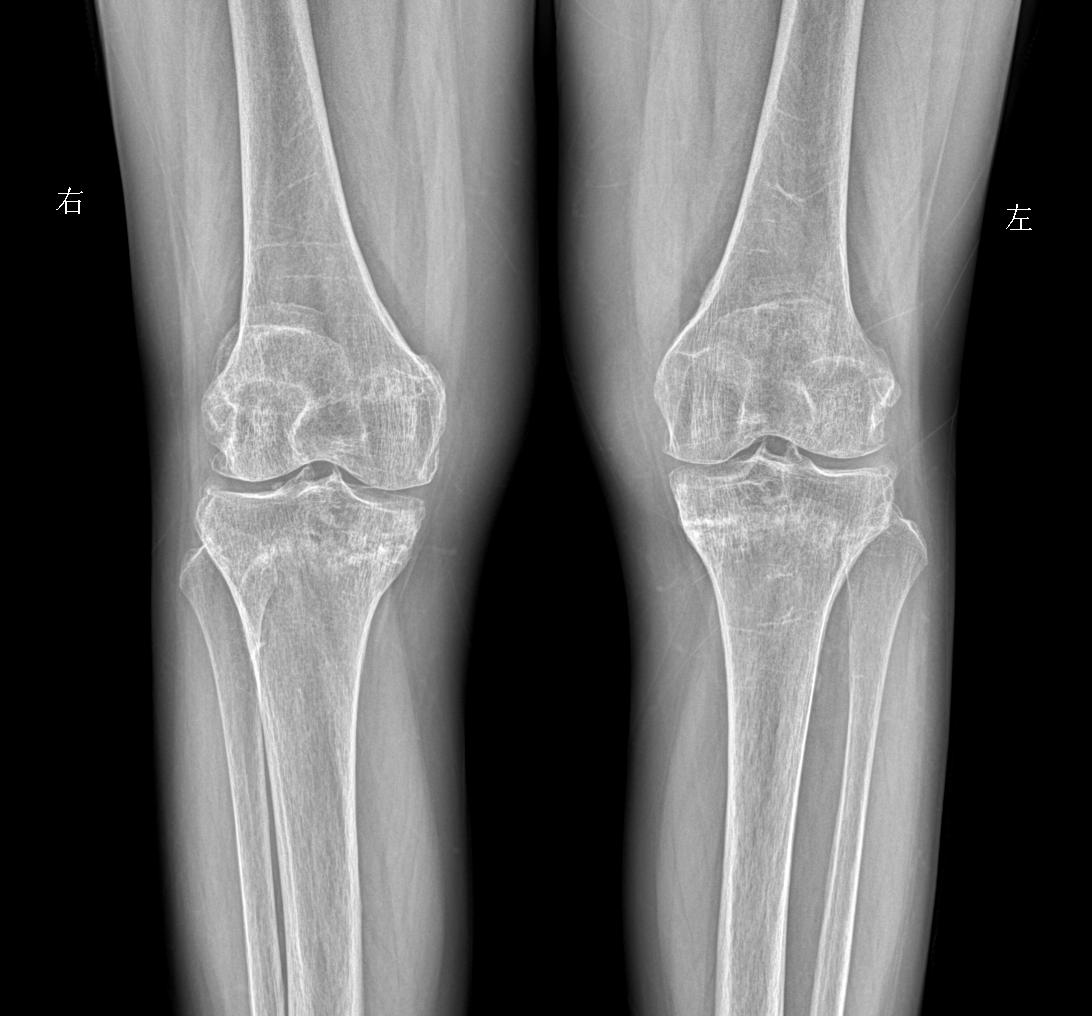 行走膝盖 脚底疼痛就诊 女69岁 考虑什么问题？