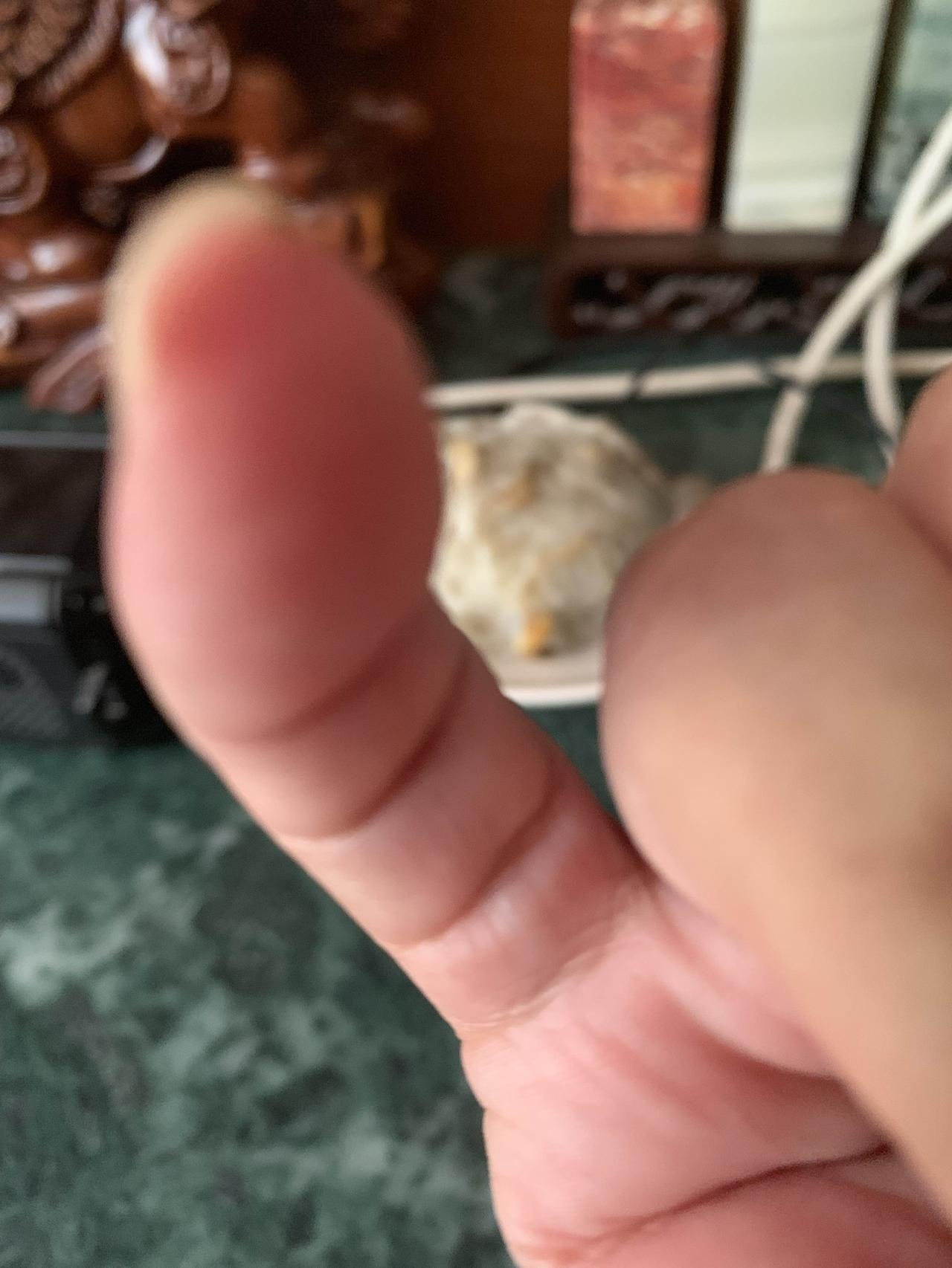 一根手指有四节，着实稀奇。若大拇指有四节纹，或许是遗传因素所致，有些人天生如此，