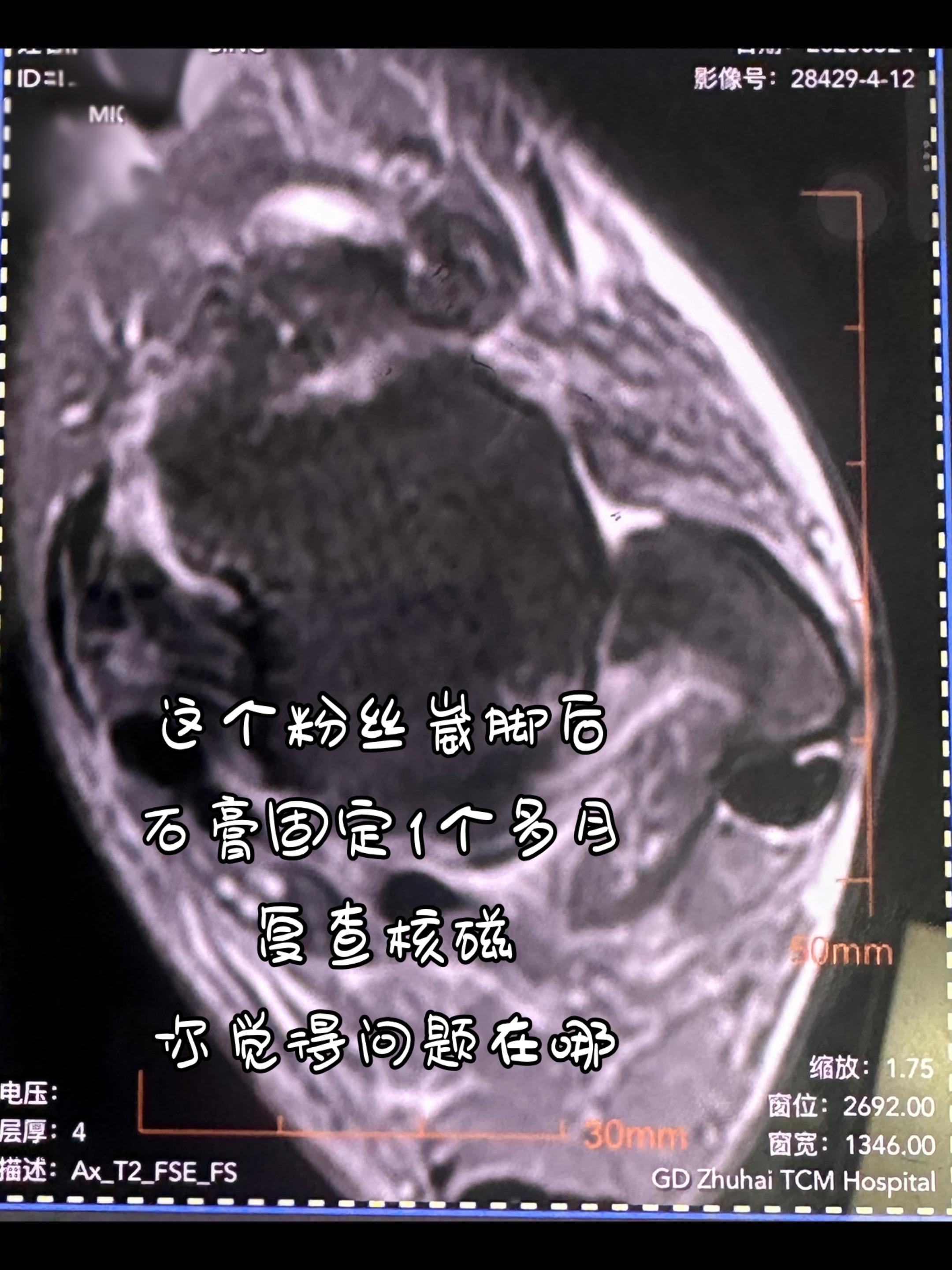 这个距腓前韧带怎么样。崴脚石膏固定了 复查核磁怎么样