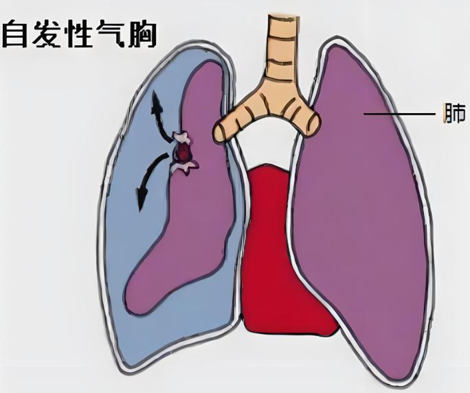 看世界杯，看得“肺炸”了？这还真不是夸张！最近世界杯激战正酣，进球精彩，比赛激烈