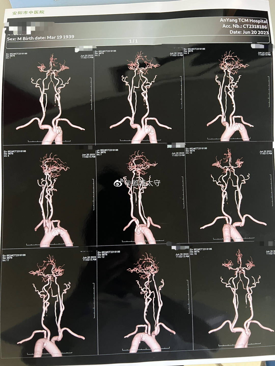 这个老爷子三月前急性脑梗入院，右椎和基底动脉重度串联狭窄，出院后治疗3个月复查了