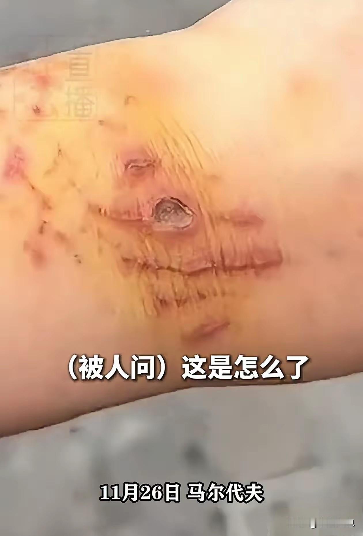 上海，一女子去马来西亚旅游，生理期来了却还坚持潜水，结果被鲨鱼咬了，朋友都好心告